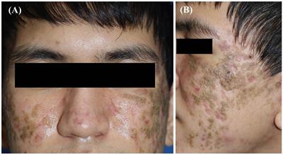 Case report: Dermatosis neglecta mimicking pemphigus foliaceus in association with obsessive–compulsive disorder